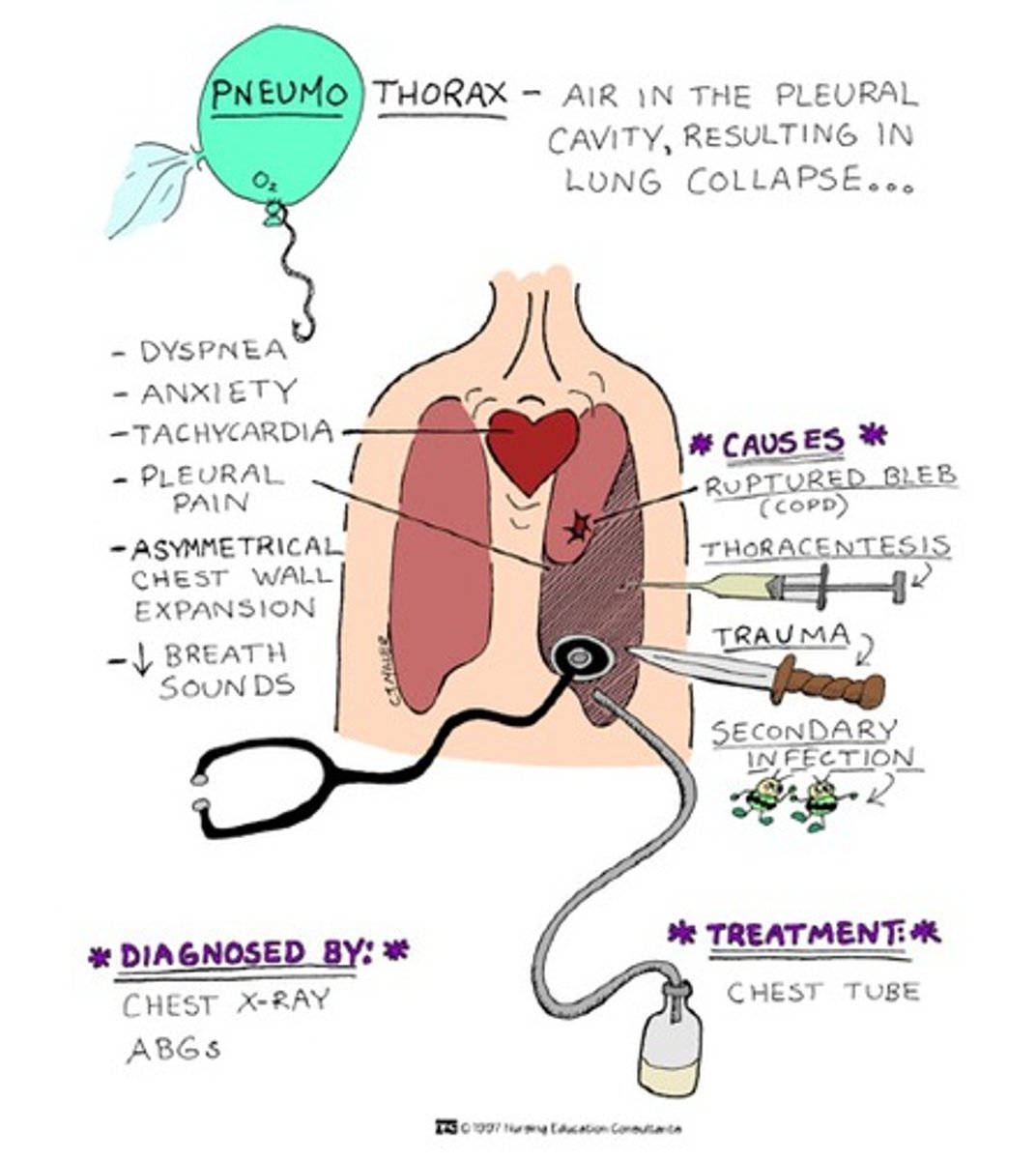 <p>the rupture of a weakened area of the lung, which allows air to escape into the pleural space</p>