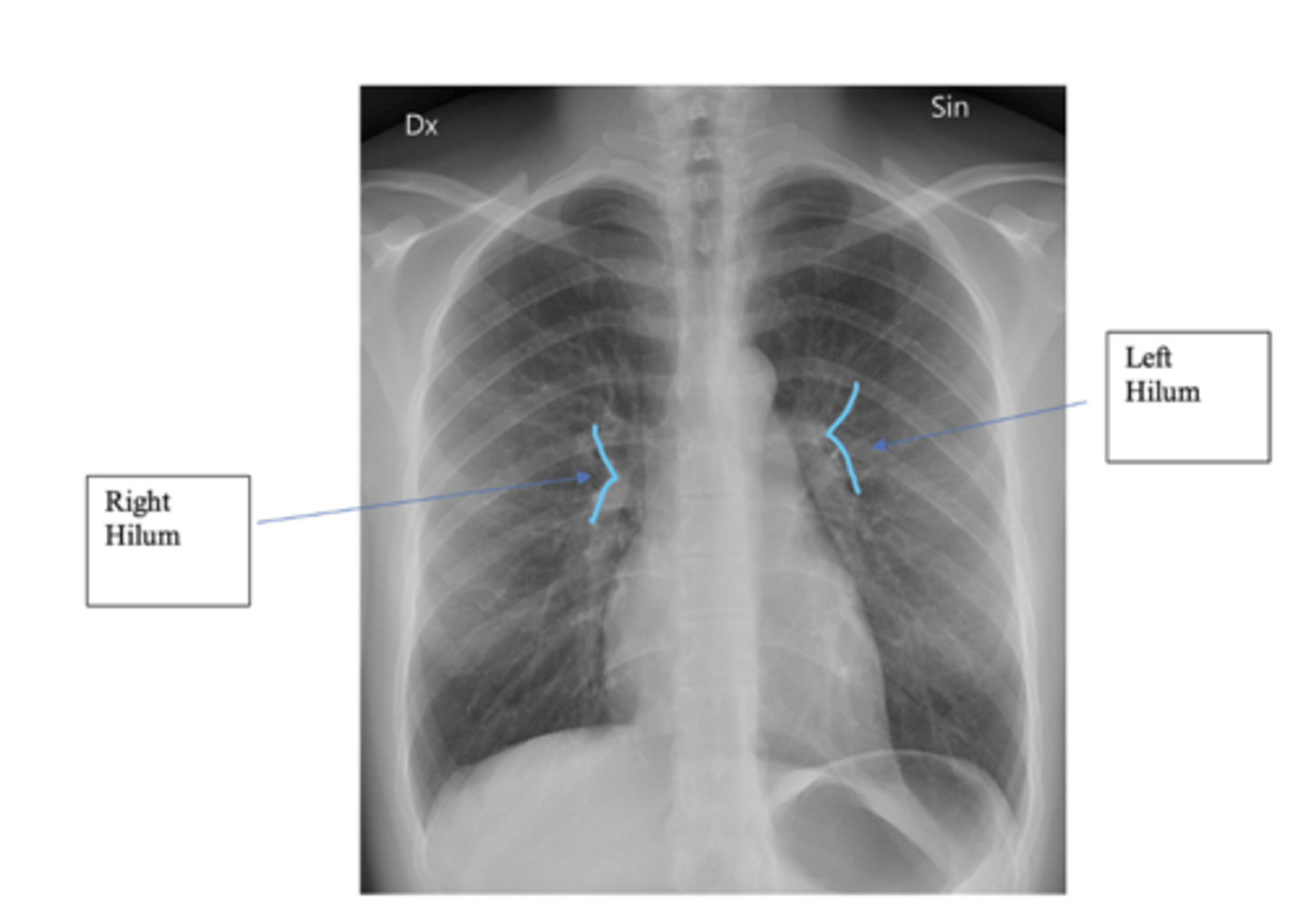 <p>•The hilar consist of the main pulmonary vasculature and the major bronchi. (wedge shaped area on central portion of each lung)</p><p>•Each hilar also has a collection of lymph nodes which aren’t usually visible in healthy individuals.</p><p>•The left hilum is often positioned slightly higher than the right, but there is a wide degree of variability between individuals.</p><p>•The hilar are usually the same size, so asymmetry should raise suspicion of pathology.</p>