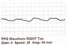 <p>What characteristics make the following waveform “abnormal”? Use terms to describe the peak, amplitude  and downslope of the waveform.</p>
