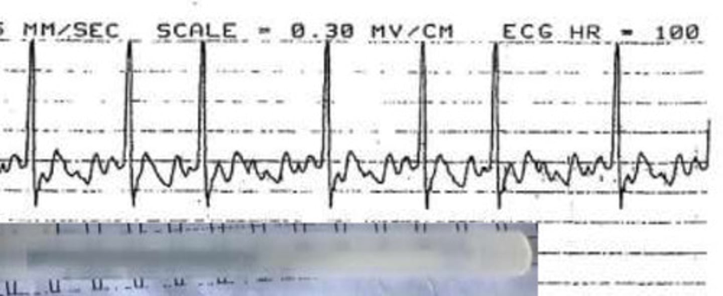 <p>What is the rhythm and rate of this ECG?</p>