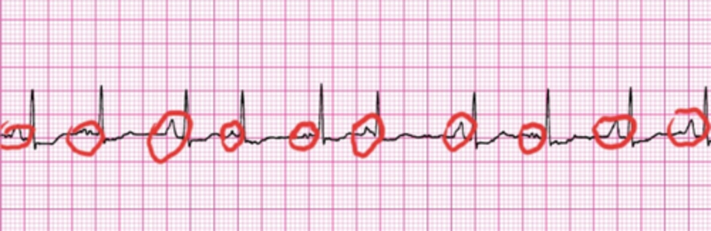 <p>3 or more varying P-Waves, overall irregular and rate is <100 ppm. Note the DIFFERENT P’s presented.</p>