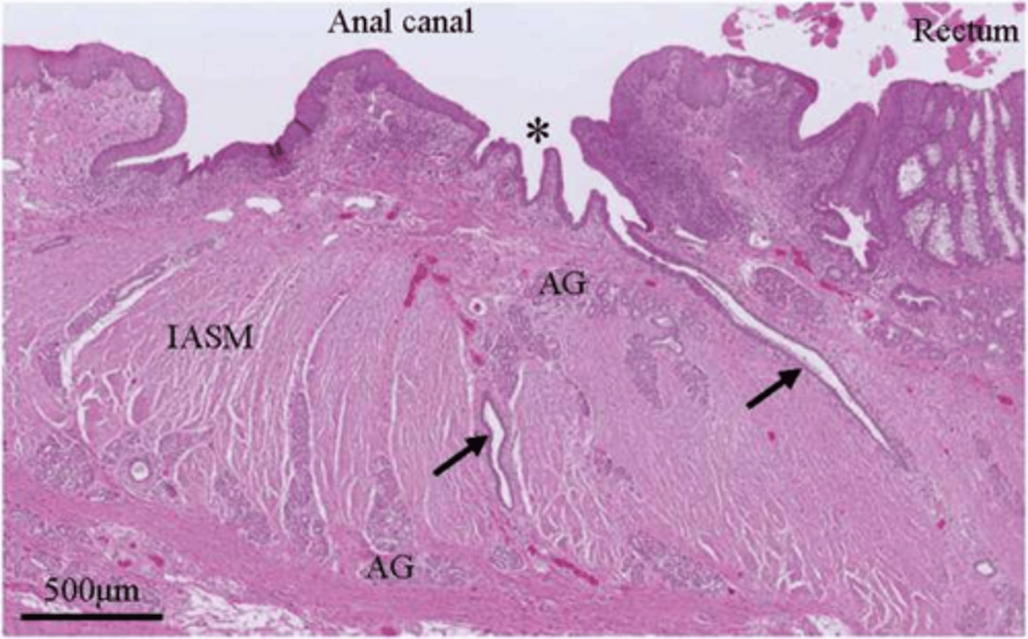 <p>Approximately 100 solitary lymphatic nodules visible as rectal pits.</p>