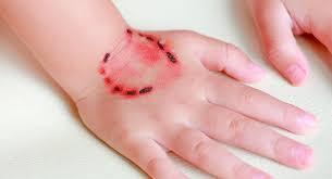 <p>Lesiones contusas que resultan de la acción punzante, cortante, dislacerante opresiva producida por los dientes.</p><ul><li><p>Humanas: forma de semicíruclo, doble paréntesis, suceden en zonas descubiertas del cuerpo, genitales o paragenitales.</p></li><li><p>Animales: acento circunflejo o de ángulo agudo, revisten aspecto dislacerante, con arrancamientos, asientan en piernas, brazos o regiones laterales del cuello.</p></li></ul><p></p>