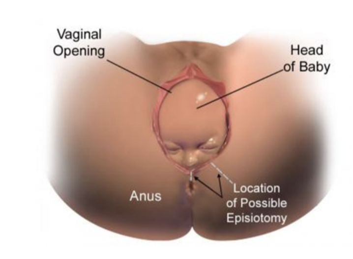 <ul><li><p>During childbirth, the perineal body may be stretched &amp; torn — traditionally felt that if a perineal tear is liekly, the obstetrician may proceed with an episiotomy</p></li><li><p>Procedure in which an incision is made in the perineal body to allow the head of the fetus to pass through the vagina </p></li><li><p>2 types —</p><ul><li><p>Median episiotomy — cuts through perineal body</p></li><li><p>Mediolateral episiotomy — incision 45° from midline</p></li></ul></li><li><p>Maternal benefits of this procedure are thought to be less traumatic to the perineum, and to result in a decreased pelvic floor dysfunction after childbirth</p><ul><li><p>HOWEVER, recent evidence suggests that an episiotomy should not be performed routinely — review of data has failed to show a decrease in pelvic floor damage with routine use of episiotomies </p></li></ul></li></ul>