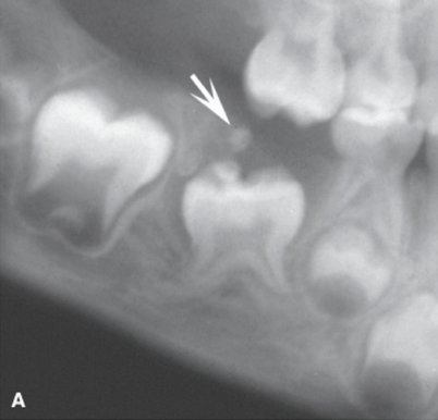 <p>non-corticated mixed RL/RO lesion in CHILDREN </p>