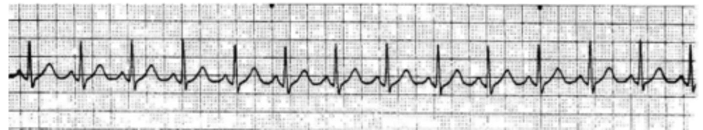 <p>heart is beating so fast, you cant see a rhythm</p><p>treat with vagal maneuvers, amiodarone, adenosine then cardioversion</p>