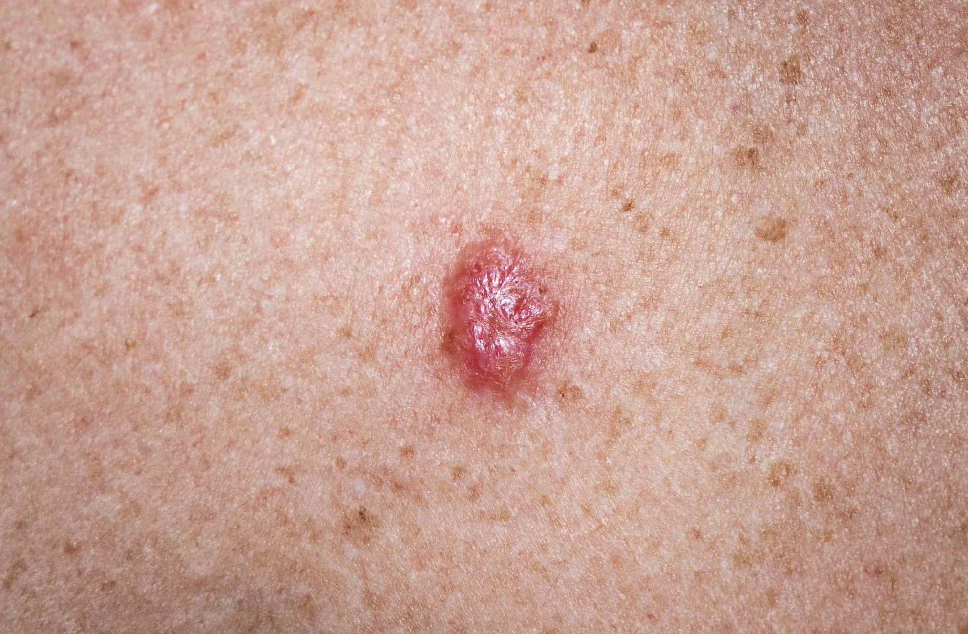 <p>A type of skin cancer that originates from basal cells in the epidermis, characterized by slow growth and a low risk of metastasis</p>