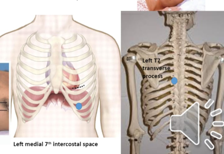 <p>anterior point: left medial 7th intercostal space <br>posterior point: left T7 transverse process</p>