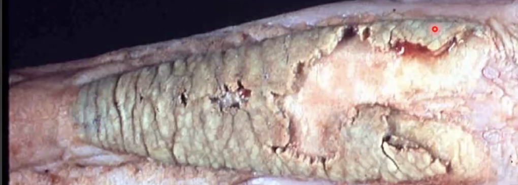 <p>What yeast infection is shown?</p>