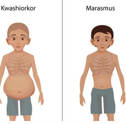 <p>childhood malnutrition, large belly, edema</p><p>lose skin, underweight, inadequate intake of proteins</p>