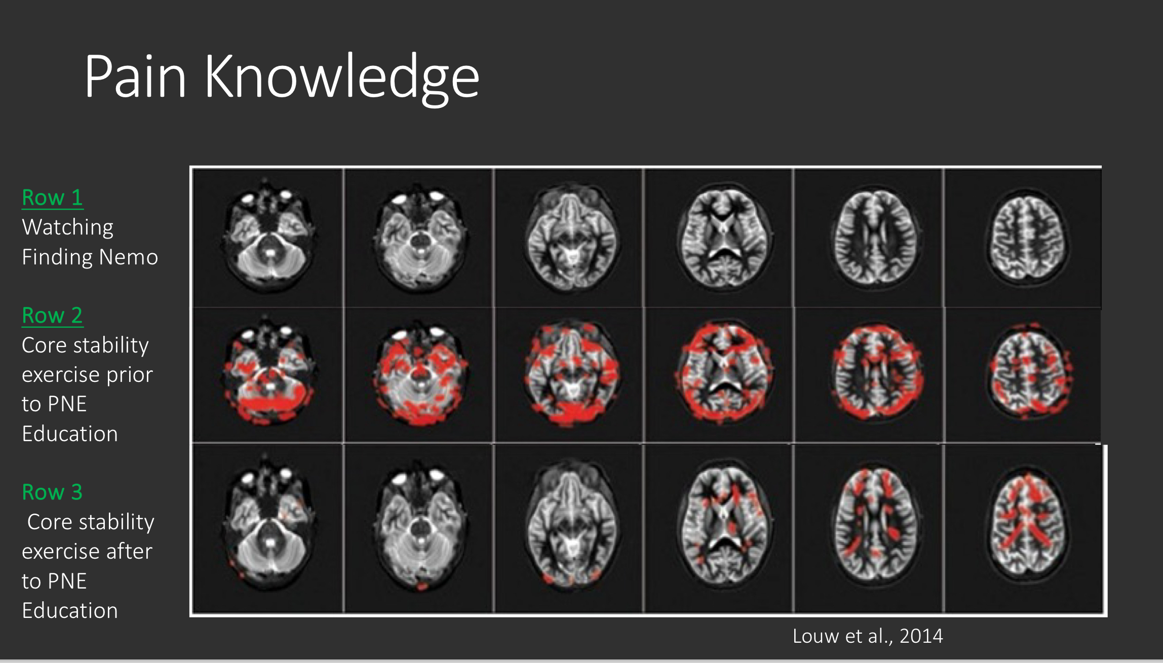 <p>more activity in brain centers before PNE education</p><p>less activity in brain centers after PNE activity (can modulate their own pain)</p>