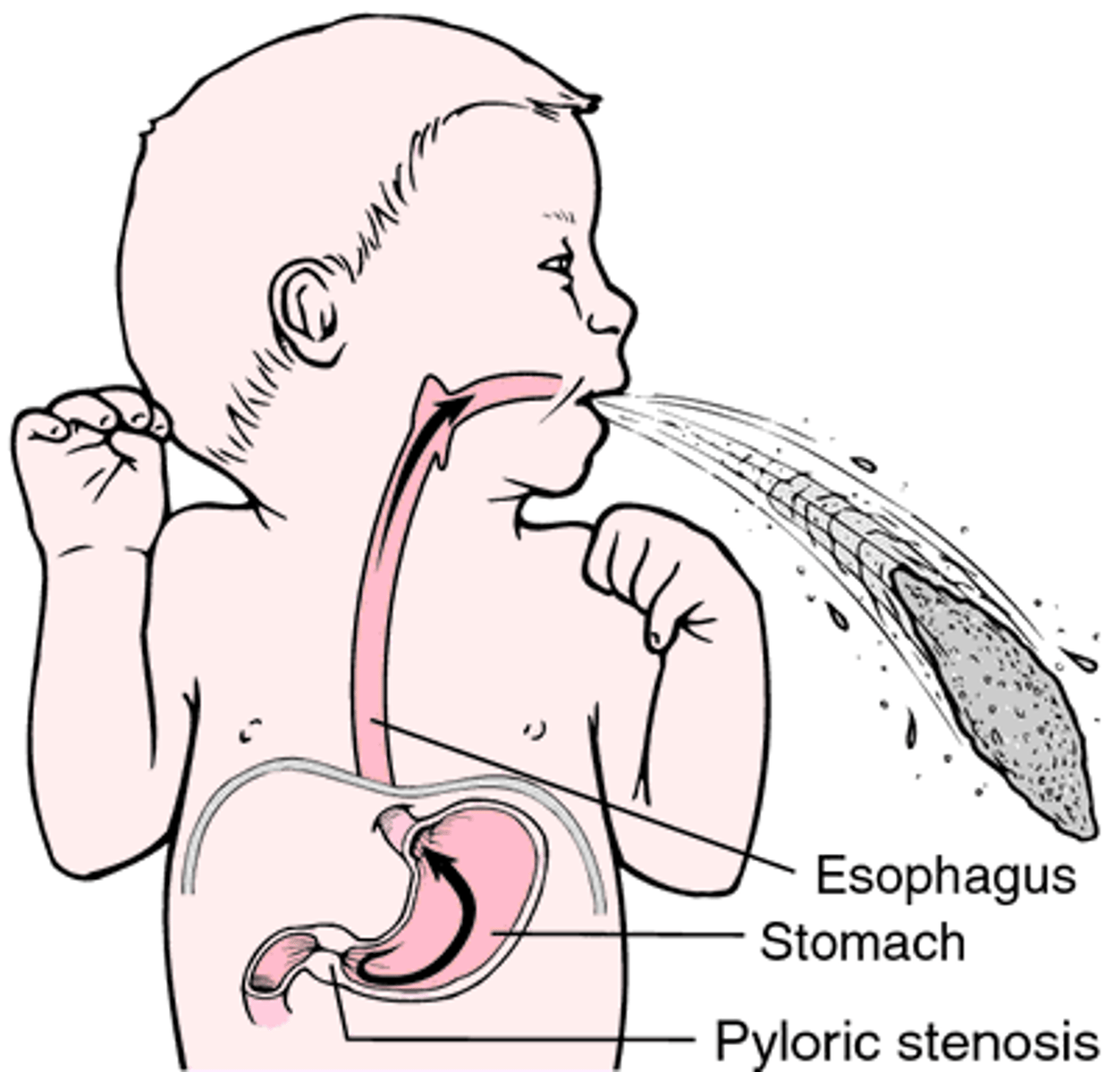 <p>narrowing of the pyloric sphincter</p><p>- usually seen in first-born, white males, at 3 wks old</p><p>- sx: projectile, non-bilious vomiting, failure to thrive, palpable olive-sized mass (very difficult to do in real life); hypochloremic (↓ Cl-), hypokalemic (↓ K+) metabolic alkalosis w/ dehydration</p><p>- tx: myotomy</p>