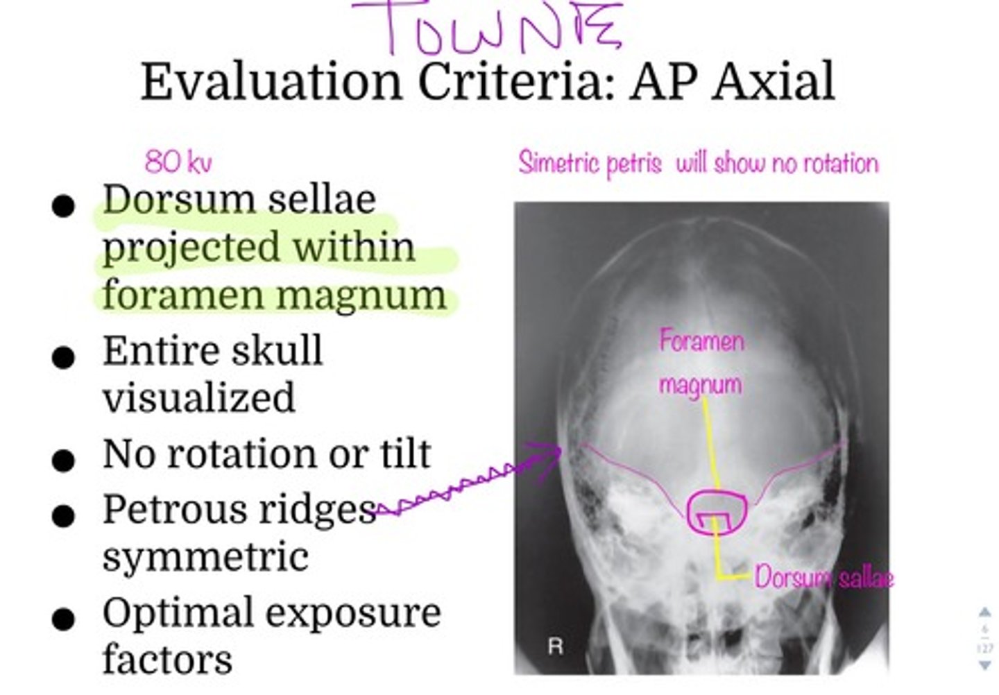 <p>C. Foramen magnum</p>