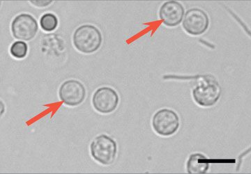 <ul><li><p>0-5/hpf is normal</p></li><li><p>associated with infection and inflammation</p></li></ul><p></p>