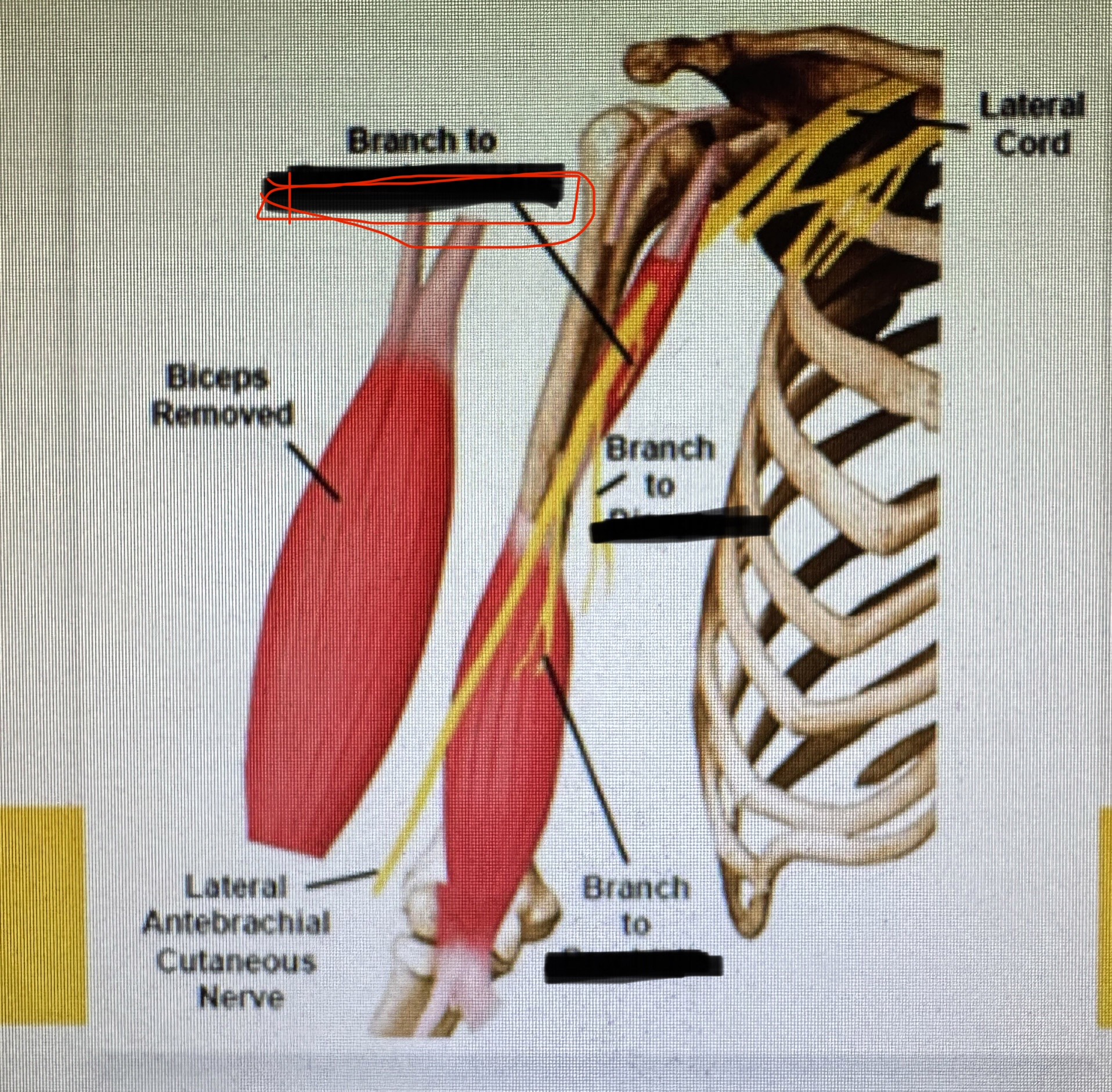 <p>musculocutaneous (cora-is)</p>