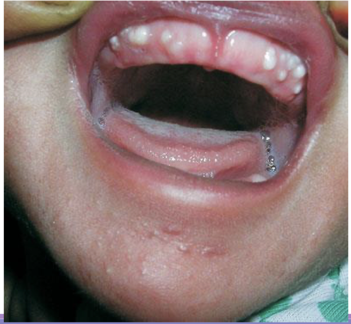 <p>A full term newborn boy, weighing 3 kg, born out of an uncomplicated pregnancy, was brought to us for evaluation of a few small, white and round bumps on the gingival surface. Examination of the oral cavity showed multiple, firm, pearly-white papules measuring 2 to 4 mm in diameter, grouped over the vestibular aspect of the alveolar ridge of the maxillary arch</p>