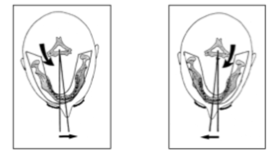 <p>Pt rotated to right → left molar closer to film (smaller) &amp; right molars further from film appear larger. </p>