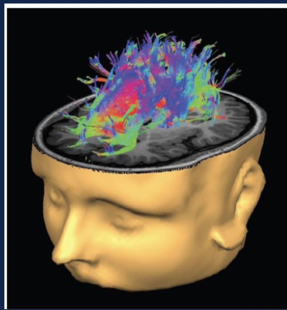 * Studying fiber pathways in the nervous system 
* uses the MRI technology to trace fiber pathways in the brain by tracking the flow of water in the nervous system 