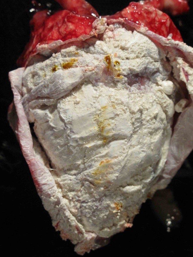 <p><span><span>The image shows the heart and pericardial sac from a bald eagle. The white, chalky material represents the deposition of urate salts. Name the condition.</span></span></p><p>Metastatic calcification</p><p>&nbsp;</p><p>Dystrophic calcification</p><p>&nbsp;</p><p>Gout</p>