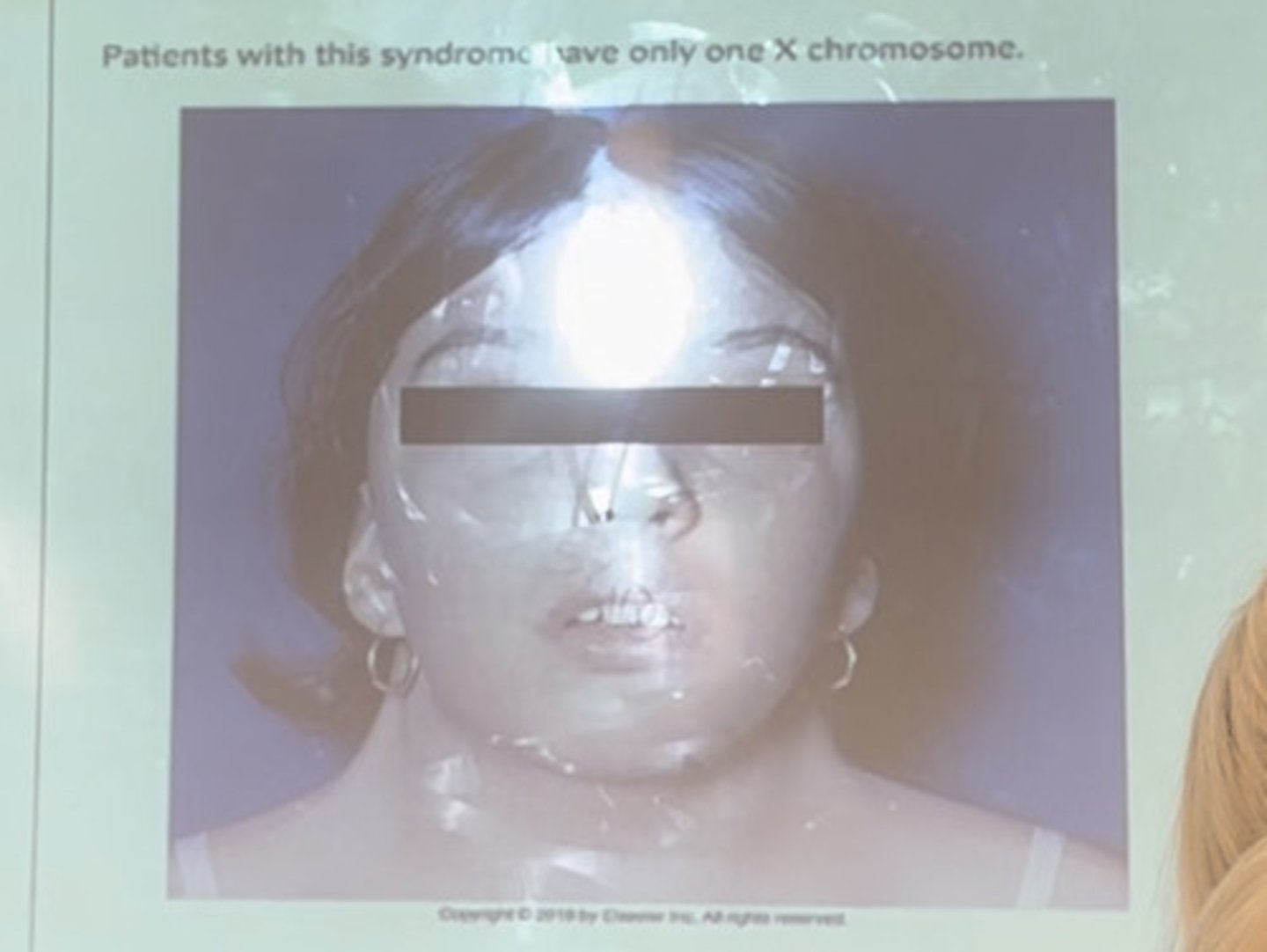 <p>Patients with this syndrome have only one X chromosome.</p>