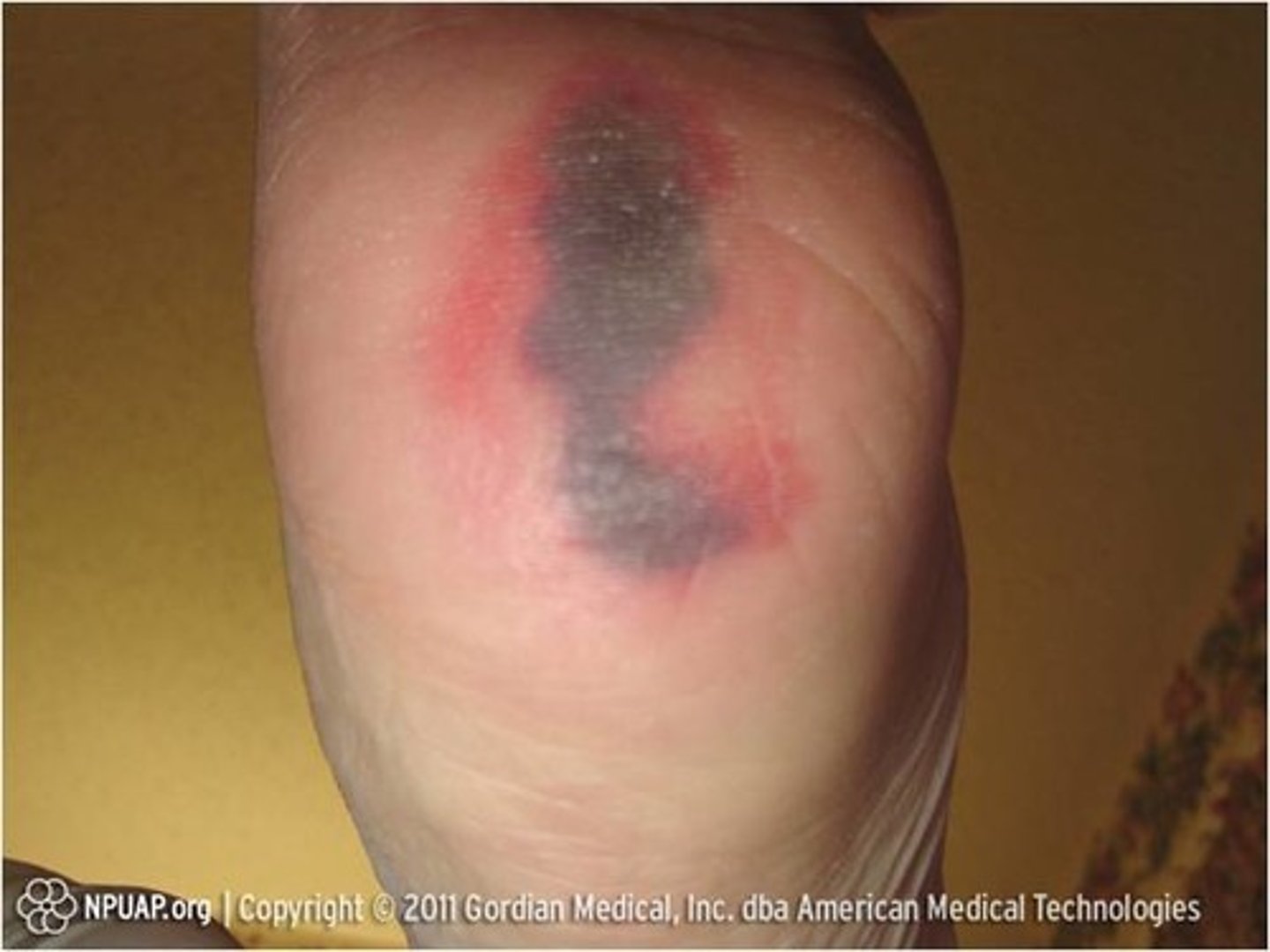 <p>i) Persistent, nonblanchable, deep red, maroon, or purple discoloration</p><p>ii) Intact or nonintact skin</p><p>iii) Can also be blood filled blister</p><p>iv) May eventually reveal tissue injury or resolve without tissue loss</p>