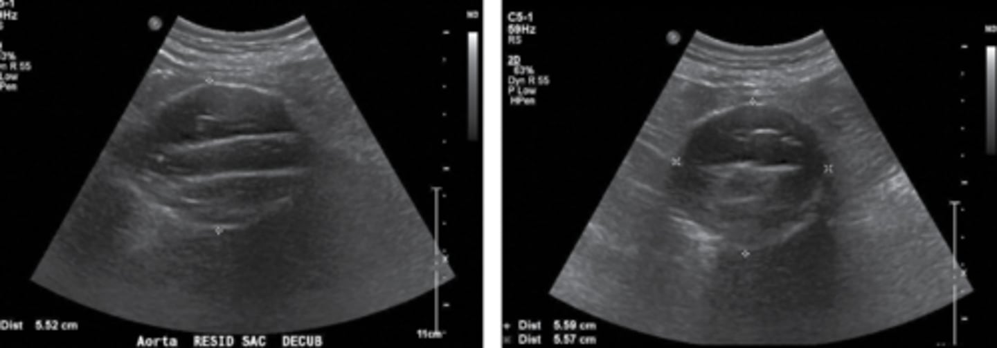 <p>Homogenous</p><p>Heterogeneous/spongy = endoleak</p>