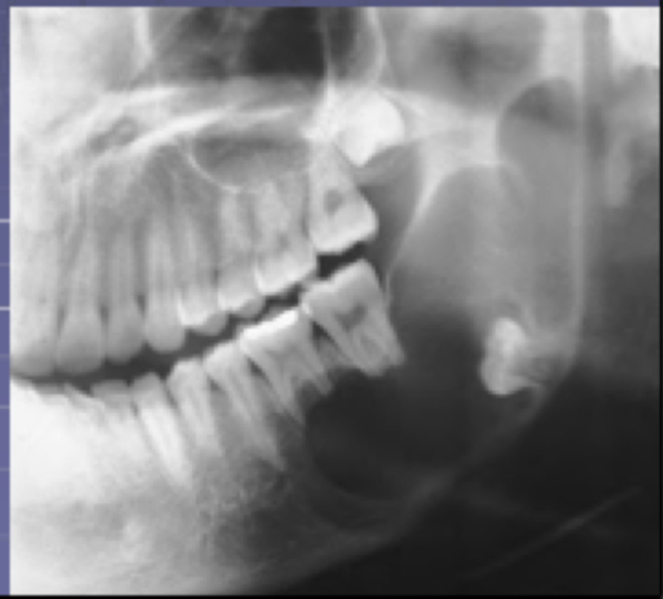 <p>-show multilocular radiolucencies in the molar areas if the mandible</p><p>-is benign, slow growing but locally aggressive epithelial odontogenic tumor that may arise in either the maxilla or the mandible</p><p>-it is a non encapsulated tumor that infiltrates into surrounding tissue and can cause extensive destruction</p>