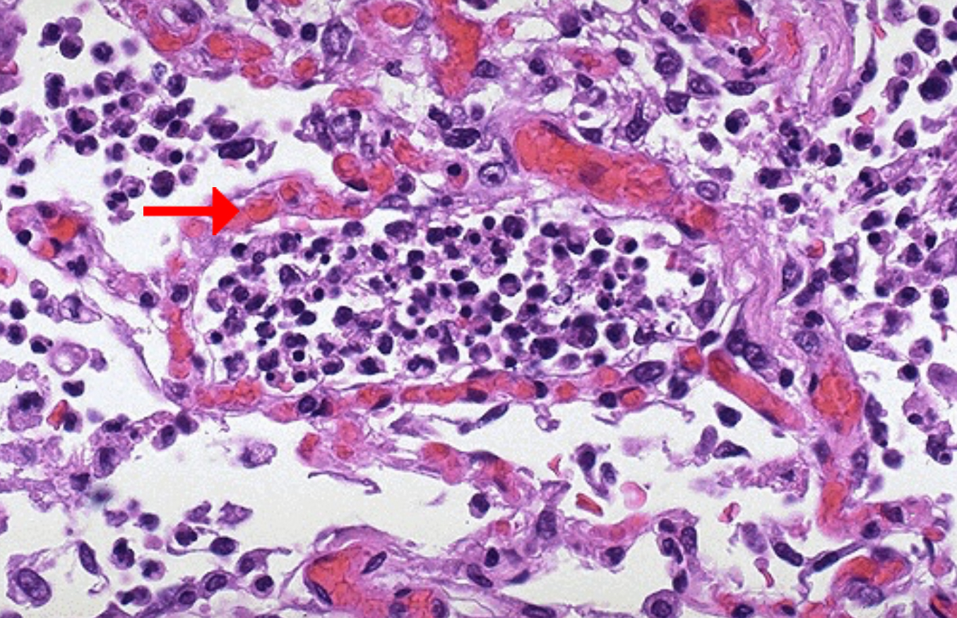 <ol><li><p>Predominant cell in the alveolar spaces</p></li><li><p>Describe the microscopic appearance of the surrounding blood vessels</p></li></ol><p></p>