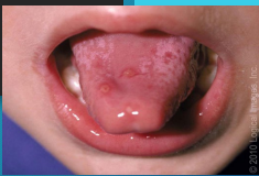 <p><strong>Hand Food Mouth Disease: Symptoms</strong></p><p>-Low grade _____ (< 101), not always present </p><p>-Oral lesions (painful)</p><ul><li><p>_______ and buccal ________ are the most common locations </p></li><li><p>Erythematous macules → vesicles → _______ with greyish-yellow base and ____ rim </p></li></ul><p>-Skin lesions</p><ul><li><p>_____ and ______ are most common. Can also see on buttocks, upper thighs, and arms </p></li><li><p>______, maculopapular, vesicular, or mix </p></li></ul><p></p>
