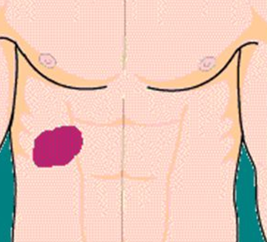 <p><span>exquisite tenderness of the right costal margin over the area of the gallbladder.  Indicates gallbladder disease</span></p><ul><li><p><span>usually gallstones or cholecystitis. </span></p></li></ul>