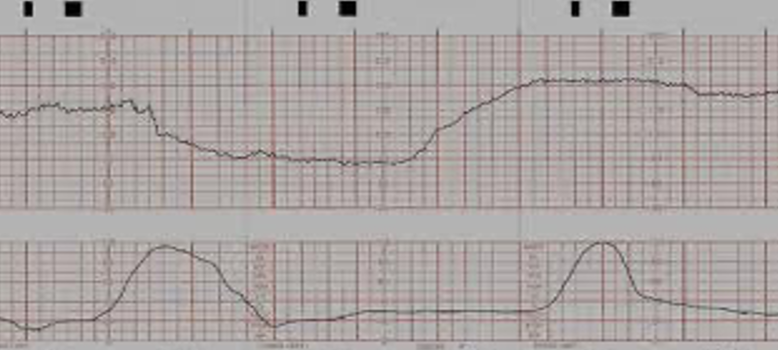 <p>- abrupt decreases in fhr below baseline that is decreased of &gt; 15 bpm lasting &gt; 2min but less than 10 min</p><p>- &gt;10 min = baseline change to bradycardia</p><p></p>