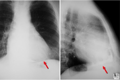<p>What does this refer to </p><ul><li><p>Pericardial calcification (lateral)</p></li><li><p>Lung fields clear</p></li></ul><p></p>