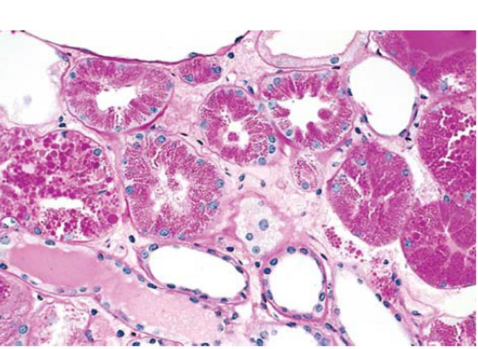 <p>hyaline change</p>