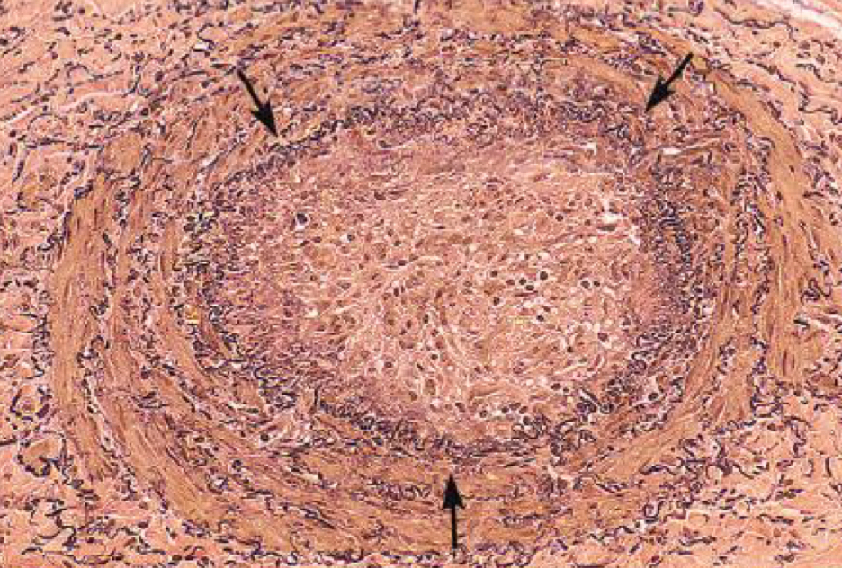 <p>what condition is depicted</p>