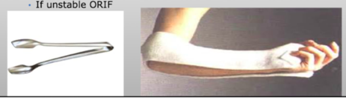 <p>Closed reduction</p><p>Sugar tong splint</p><p>Repeat XR</p><p>If unstable → ORIF</p>