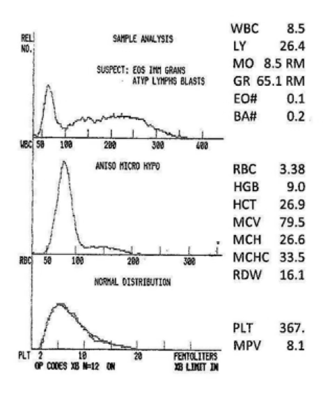 <p>what type of anemia is present?</p>