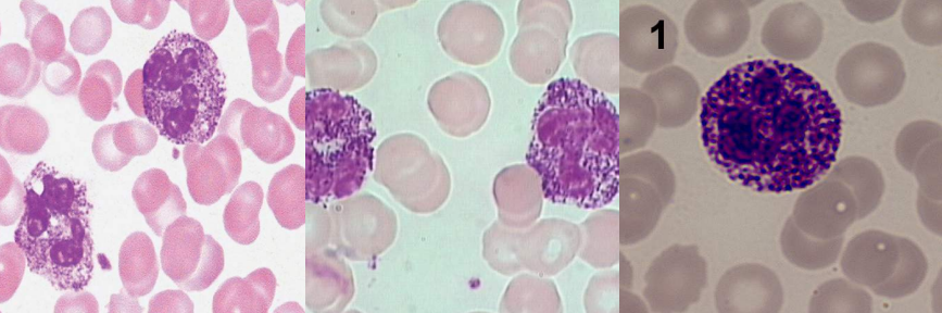 <p>A. Identify the abnormality / cell</p><p>B. This is seen in what condition / disease</p>