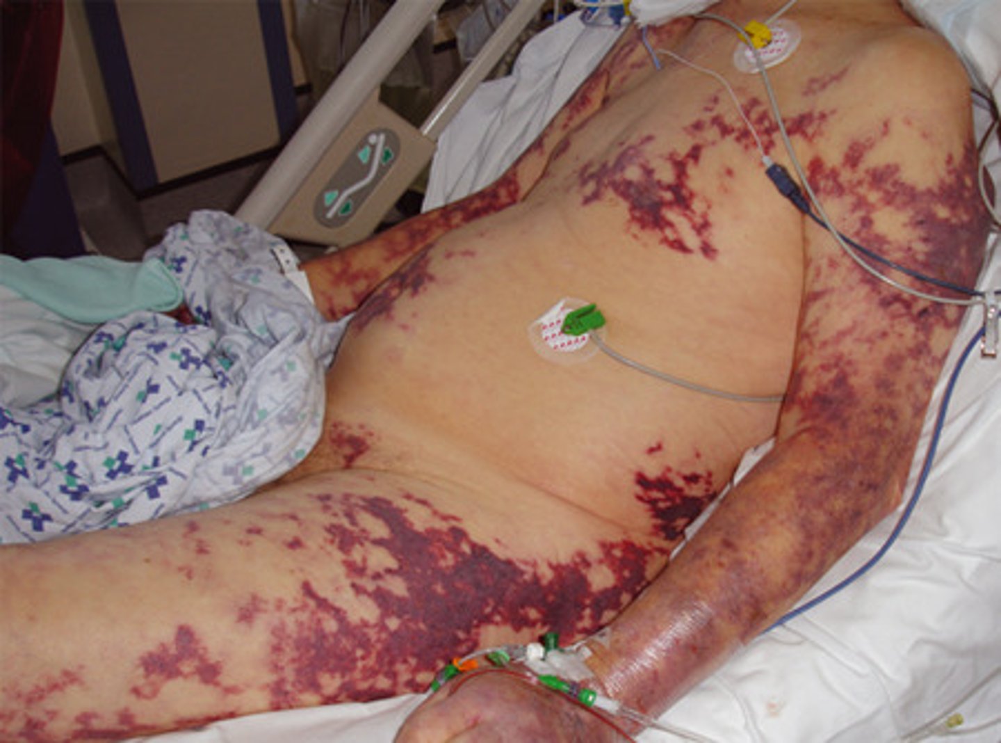 <p>•neonatal homozygous form of protein C or S deficiency seen as widespread venous thrombosis and skin necrosis (also seen with meningococcus and gram-negative infections, DIC)</p>