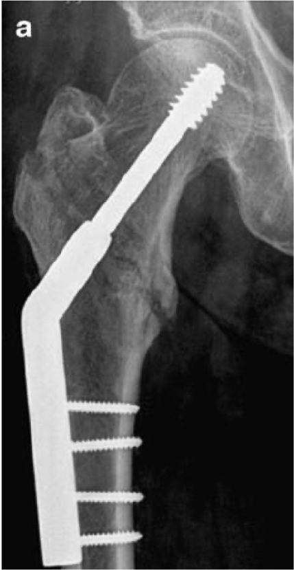 <p>large screw with side plate and several small screws</p>
