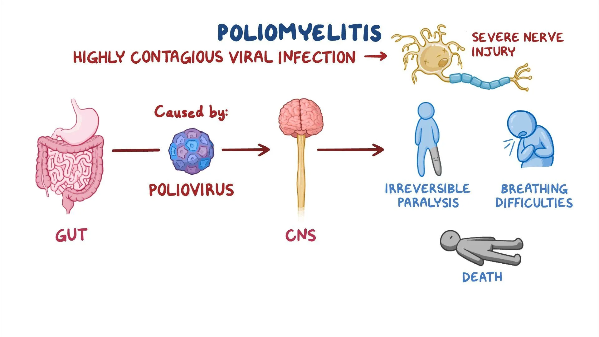 <p>What is a <strong>key symptom</strong> of Poliovirus disease?</p>
