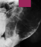 <p><span>What are the radiographic borders of ABC like?</span></p>