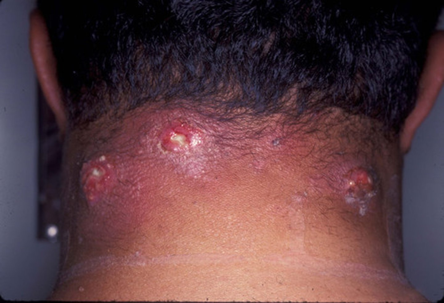 <p><strong>Antibiotics That Inhibit Cell Wall Synthesis (Penicillins)</strong></p><p></p><p>Methicillin-resistant <em>Staphylococcus aureus</em> is commonly called?</p>