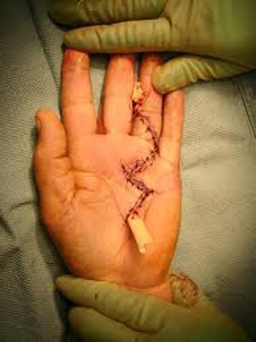 <p>A penrose drain is a piece of latex tubing placed under the skin. The purpose of the drain is to allow fluids such as blood or pus to drain from the space between the skin and muscle to allow healing. The fluids will drain out between the skin and the tube, not through the center of the tube.</p>