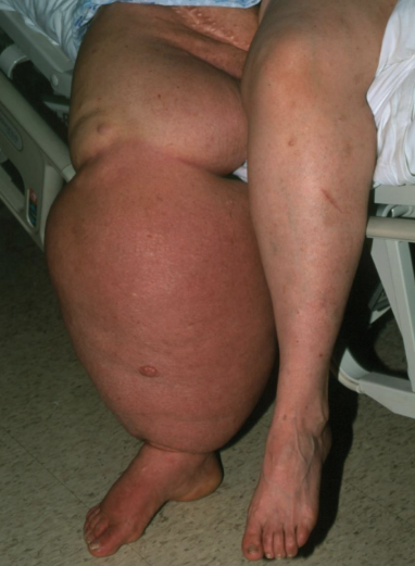 <p>Caused by the parasitic roundworm <em>Wuchereria bancrofti</em></p><p>Transmitted by mosquitoes</p><p>Larvae infect the lymphatic system</p><p>They damage vessels and glands</p><p>After years of infestation, arms, legs, and scrotum swell and distort, a.k.a. elephantiasis, lymphedem</p>