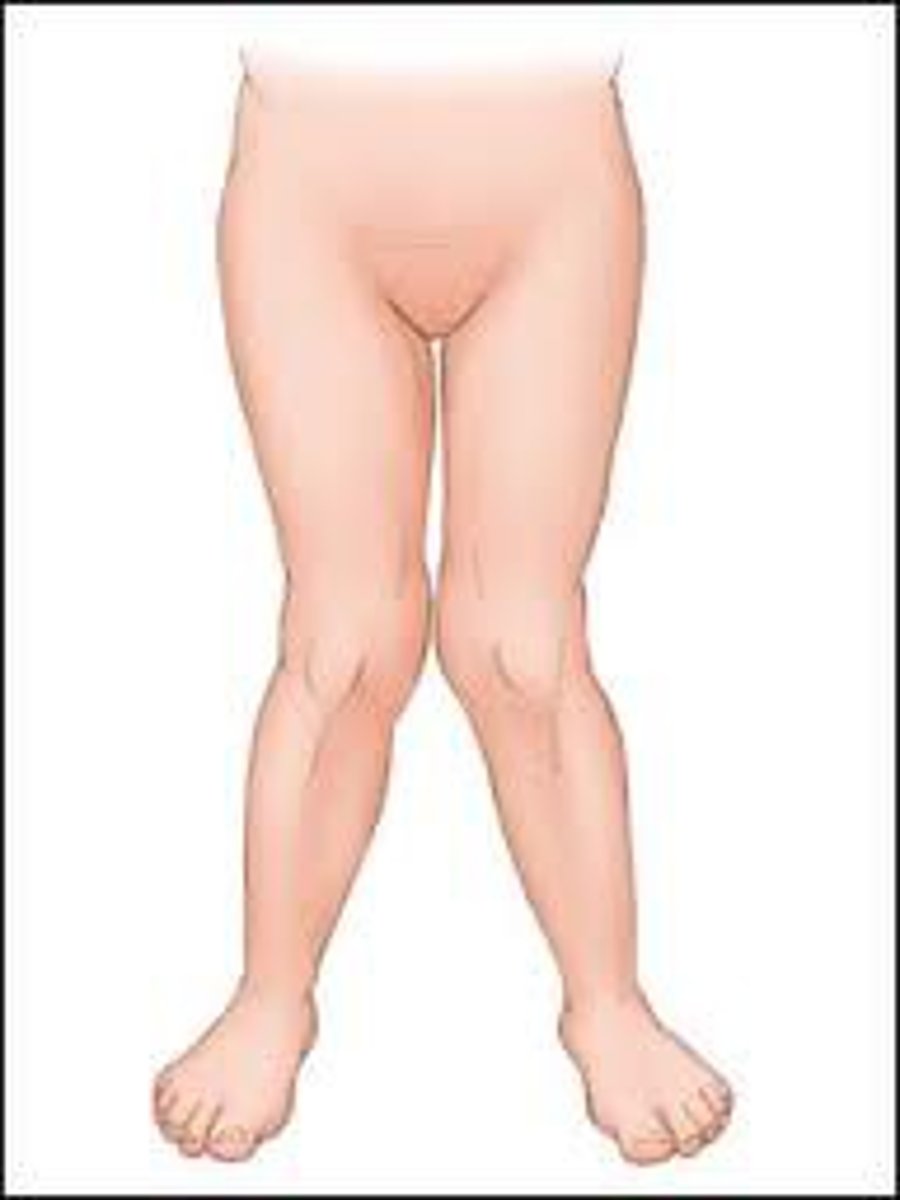 <p>A deformity in which the knees are abnormally close together and the space between the ankles is increased due to a lateral angulation of the tibia in relation to the femur</p>