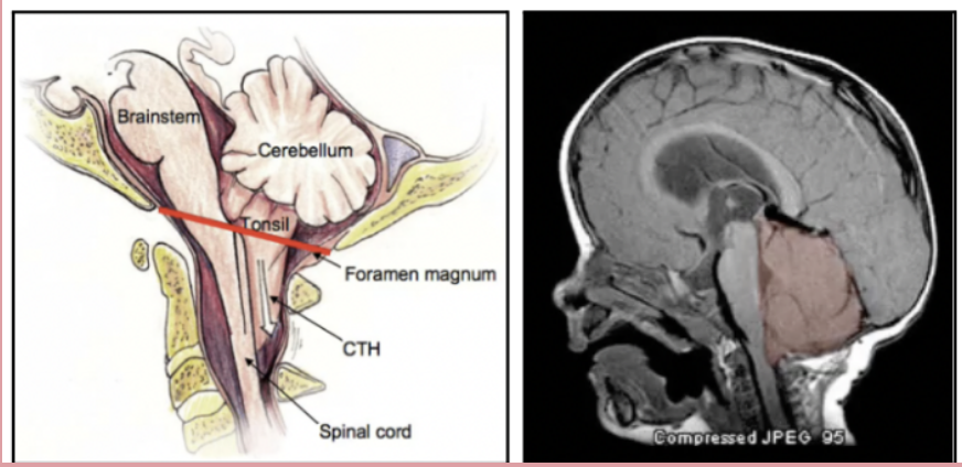 <p>Cerebellum herniates down through the foramen magnum which is produced by an increased intracranial pressure. This results in the compression of the pons and medulla and can result to death by cause of cardiopulmonary arrest. Manifestations: Pupil constriction, impaired arousal, Cheyne-Stokes respiration, Decorticate (Flexor) Posturing, Coma, and extremely poor prognosisFro</p>