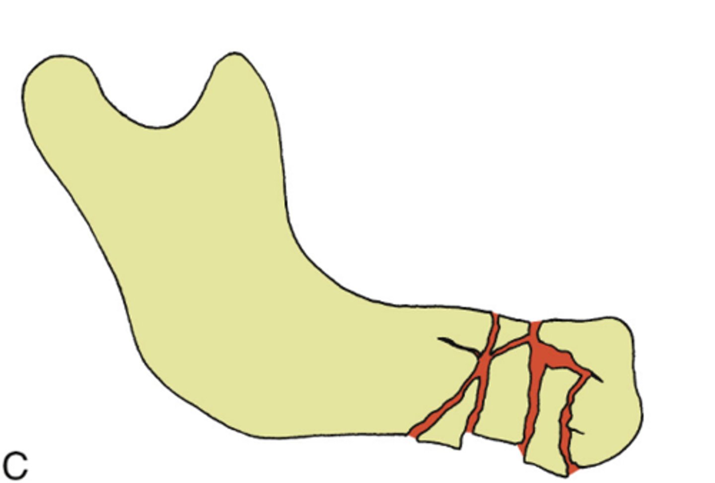 <p>ID the type of mandibular fracture:</p><p>•a fracture in multiple pieces</p><p>•Often from a high energy injury</p>