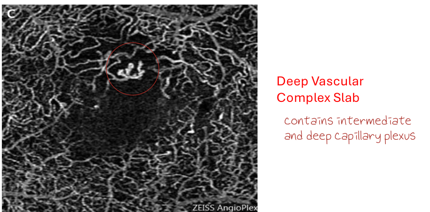 <p>disorganization of capillaries with focal areas of bulging seen in deep vascular complex slab</p>