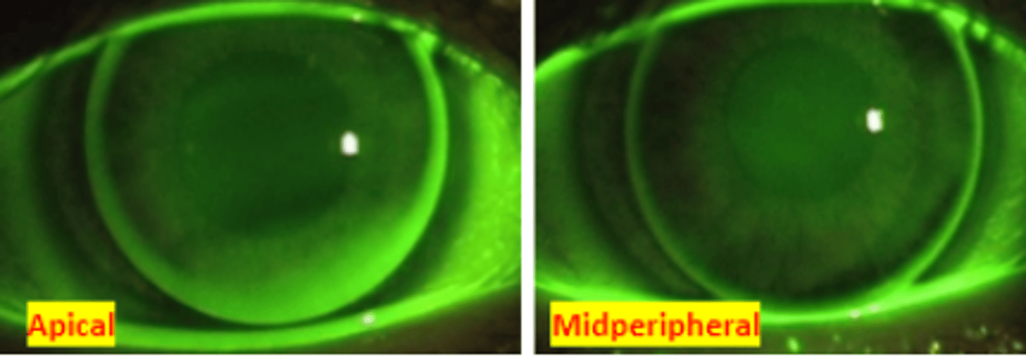 <p>fluorescein pattern observed when the back surface of the lens matches the corneal curvature. Results in a plano lacrimal lens</p>