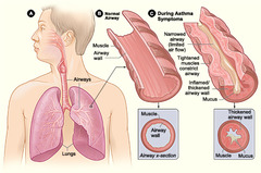 <p>A lung disease characterized by inflamed, narrowed airways and difficulty breathing.</p>